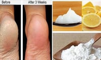 Treatment for cracked heels at home 